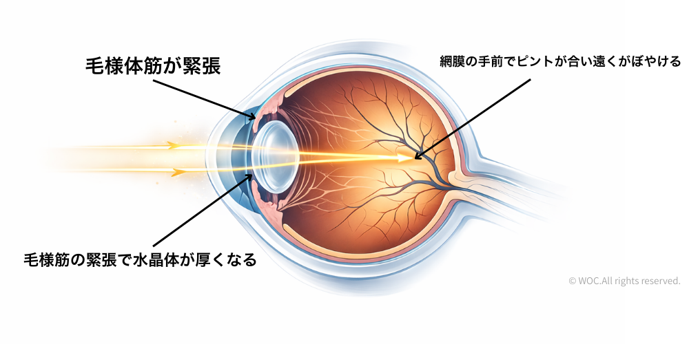 ワックの仮性近視図解画像